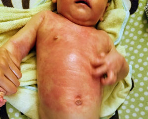 child with severe eczema itching