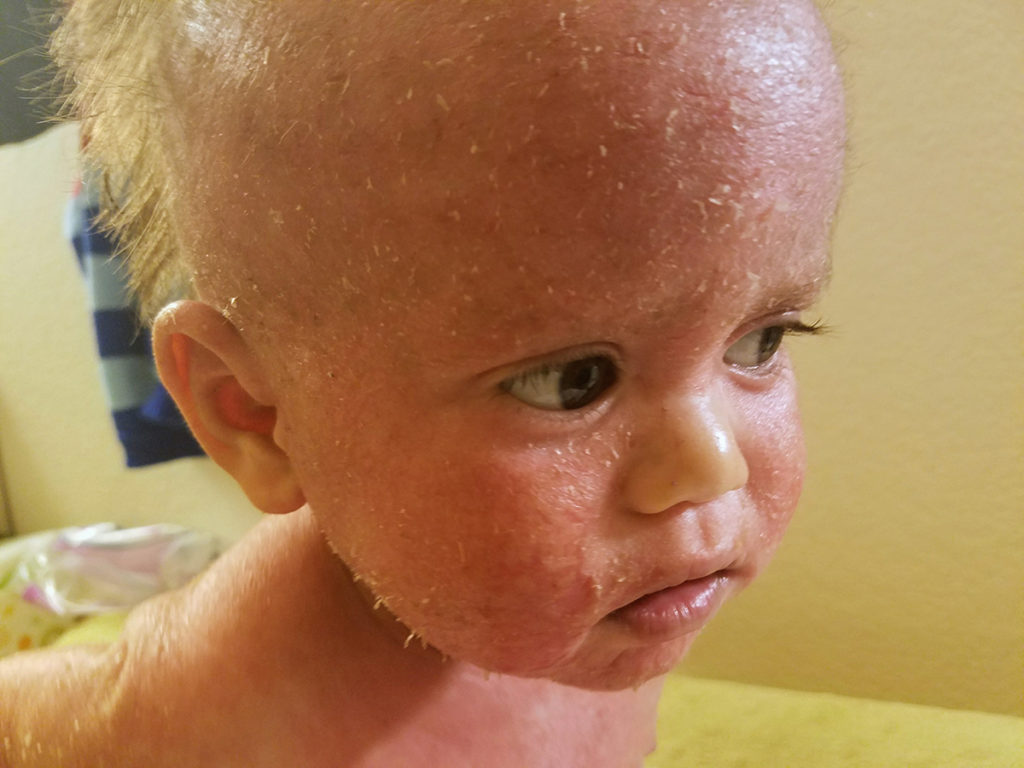 child with dry eczema on face