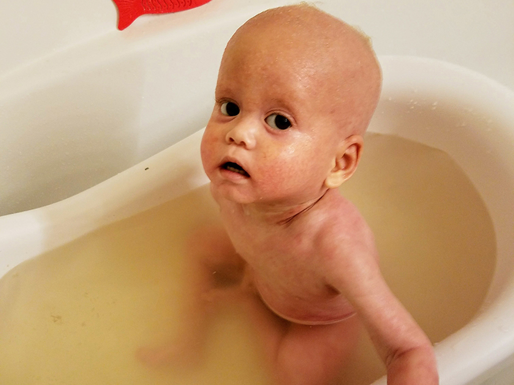 child with severe eczema in apple cider vinegar bath