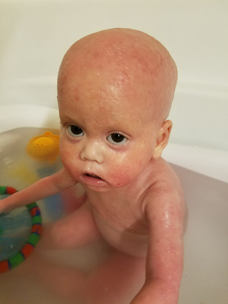 child with severe eczema, failure to thrive, leaky gut, vomit, diarrhea