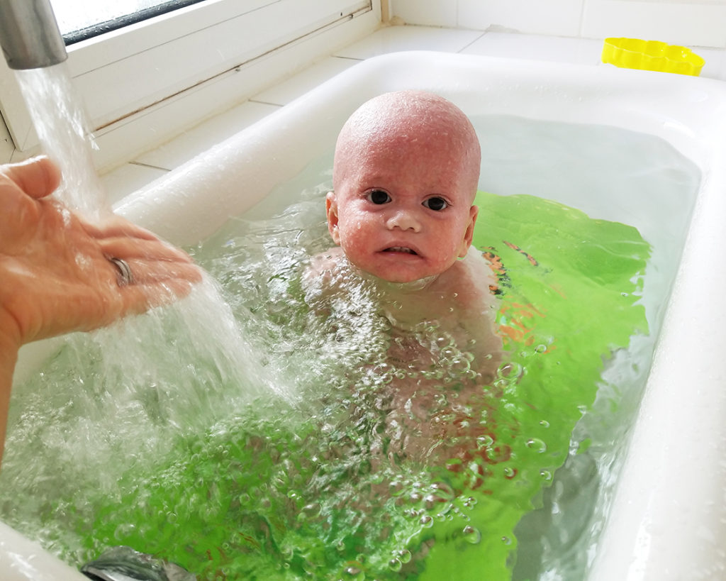 baby with eczema at the Avene hydrotherapy center