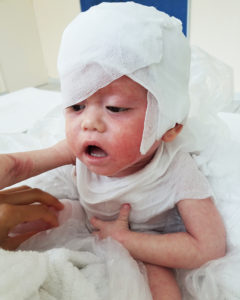 baby with eczema compress at avene hydrotherapy center