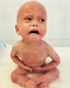 baby with eczema at avene hydrotherapy center before treatment