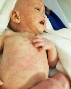 baby with eczema