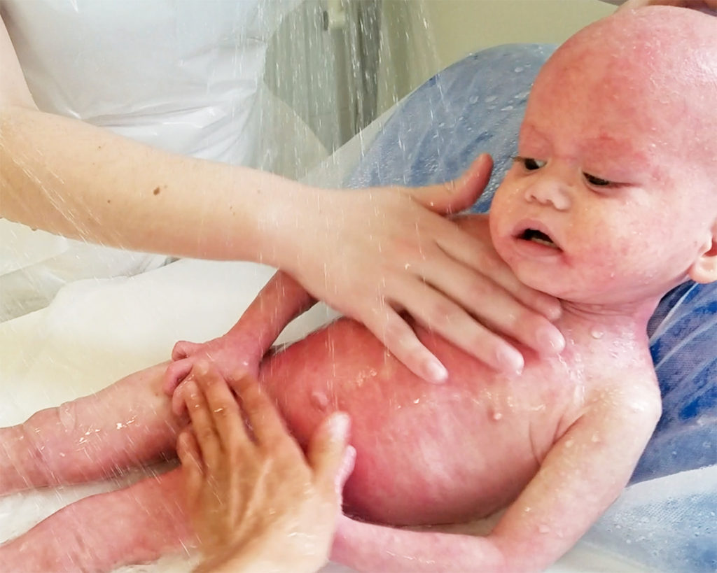 baby with eczema underwater massage at the avene hydrotherapy center