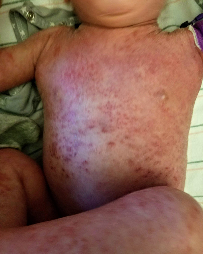 allergic reaction hives at hospital